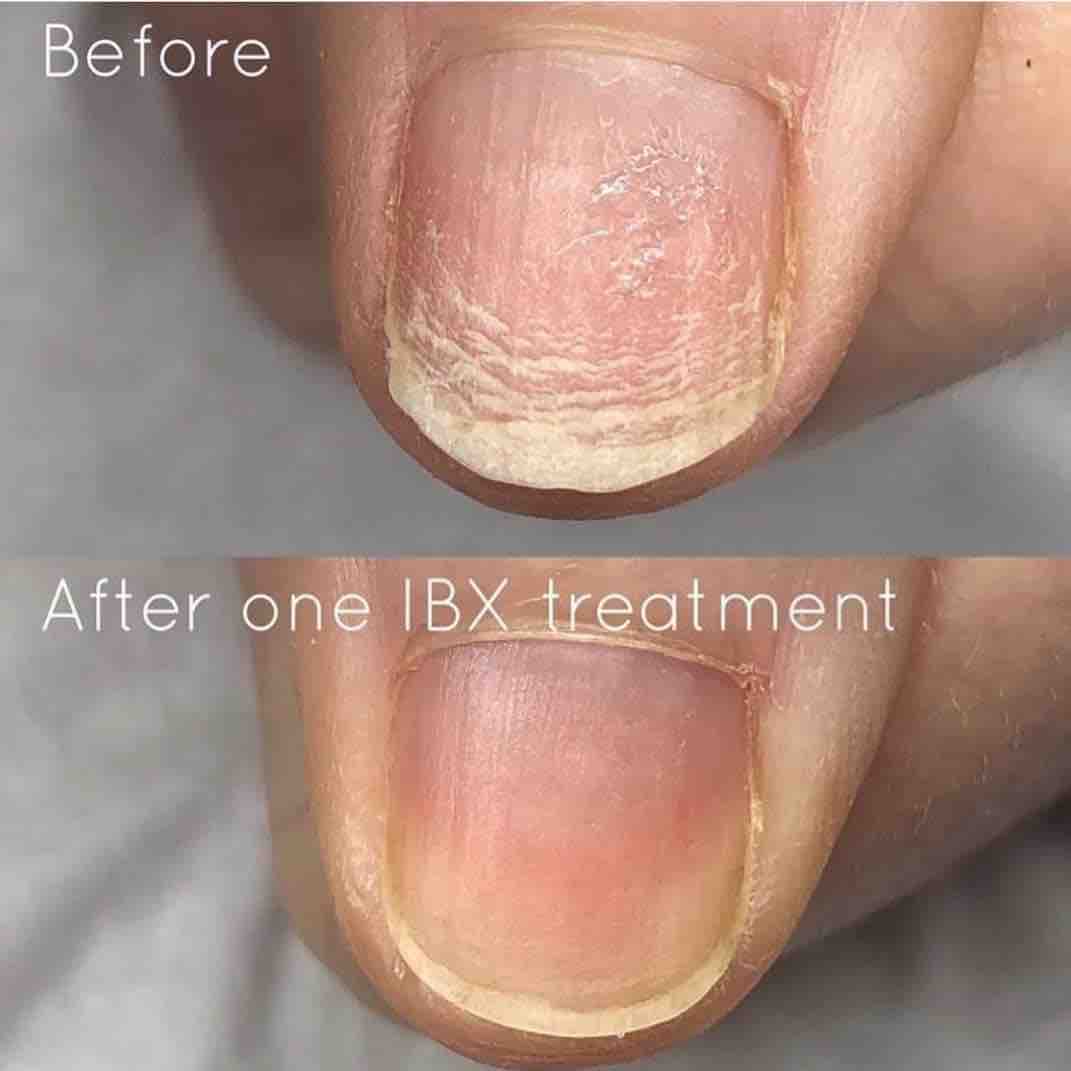 Follow Up IBX Treatment