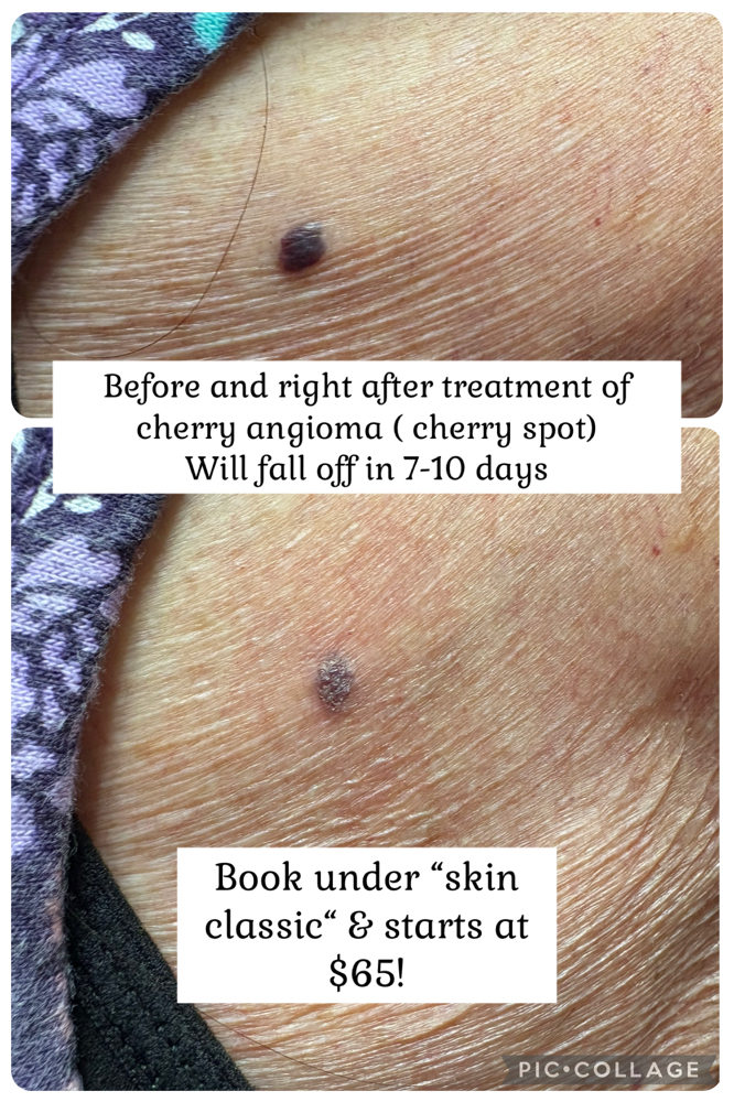Skin spot Treament