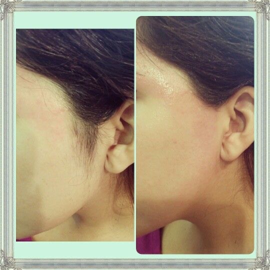 Sideburn Hair Removal at Yulee Mac Aesthetics in Tontitown, AR