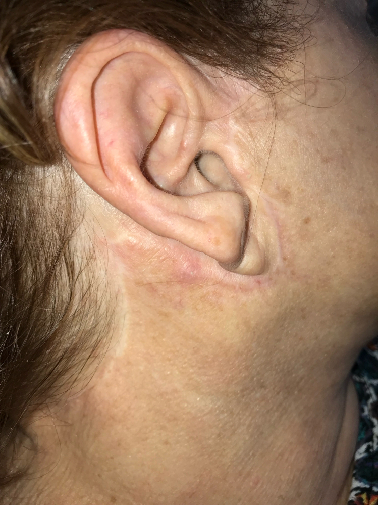 Consultation Scar Camouflage