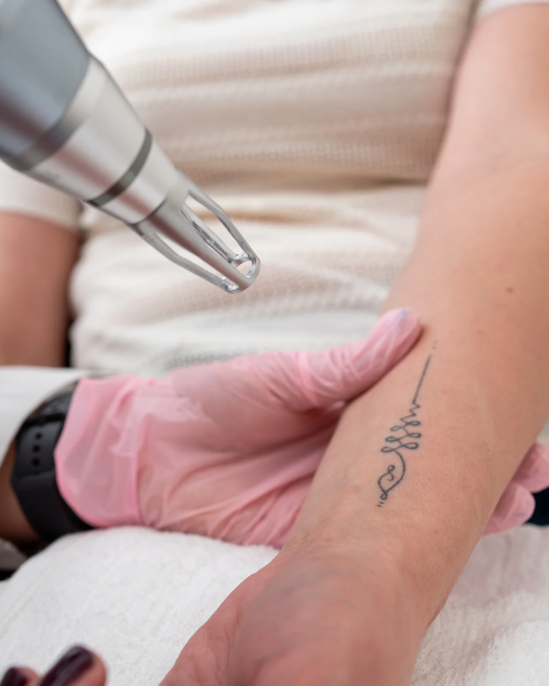 One Small Area Tattoo Removal at M.A.V Aesthetics in Fort Morgan, CO