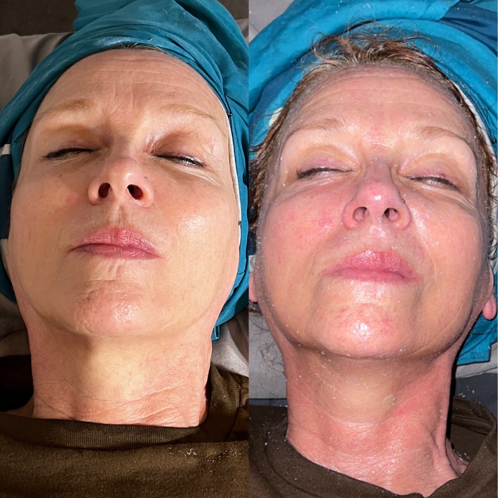 Face Lift Facial