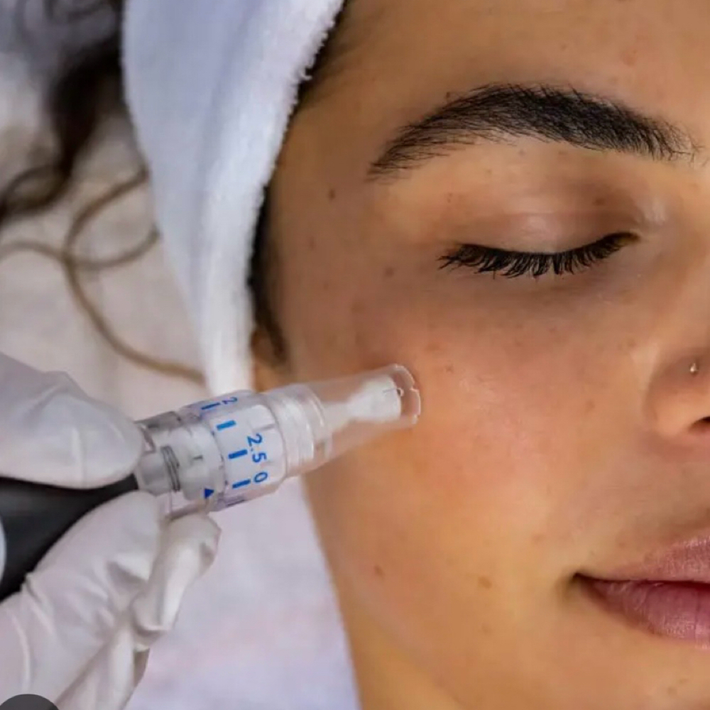 Micro Needling With Exosomes Face at Snatched Waxing & Aesthetics in Denver, CO