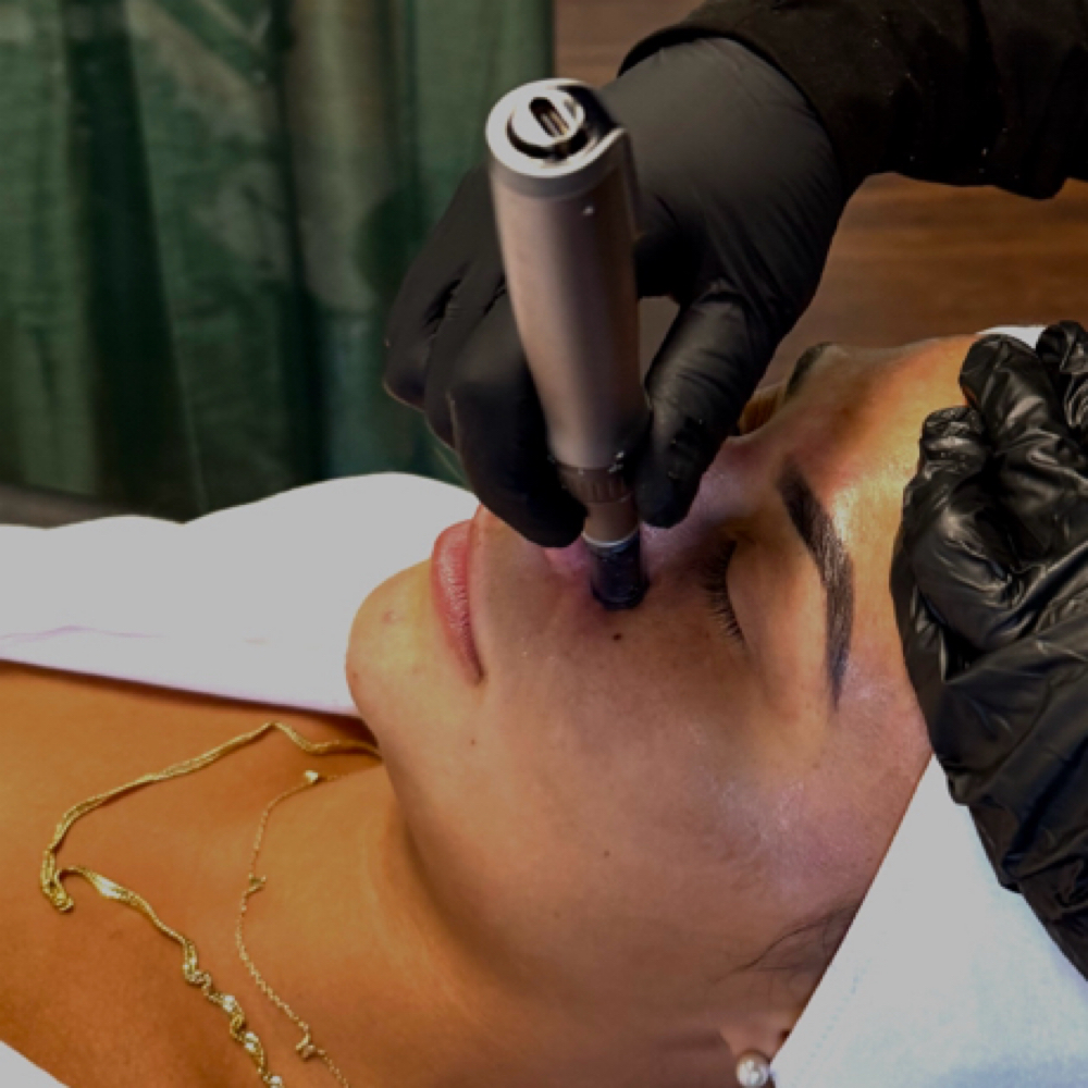 Traditional Microneedling at Haus of Hands Body Bar in Gahanna, OH