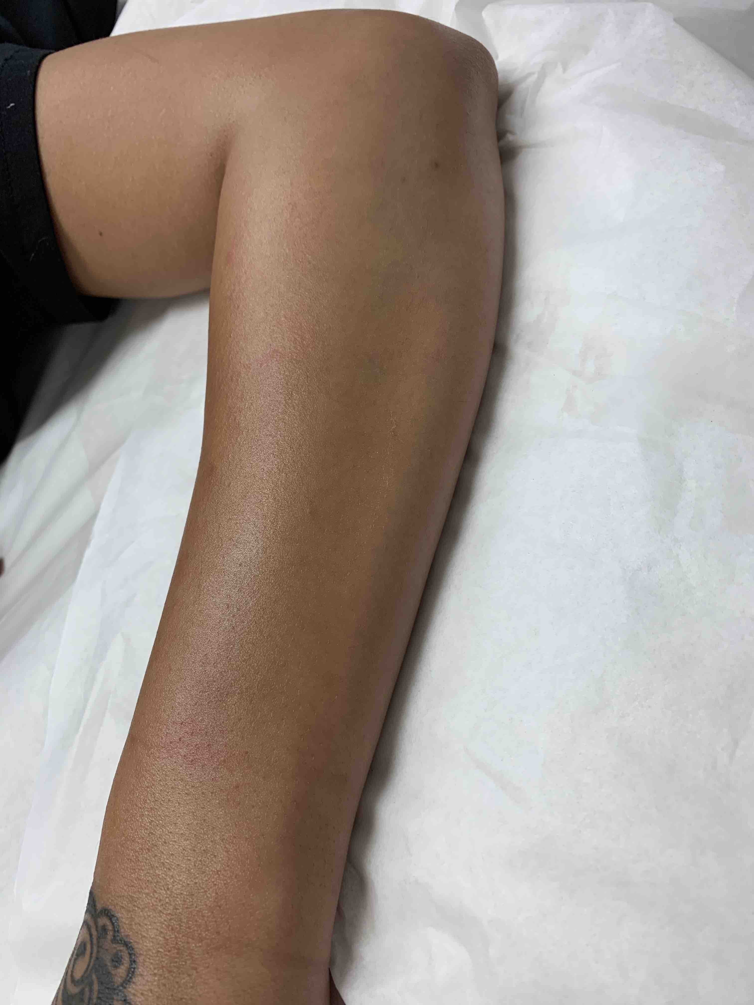half arm