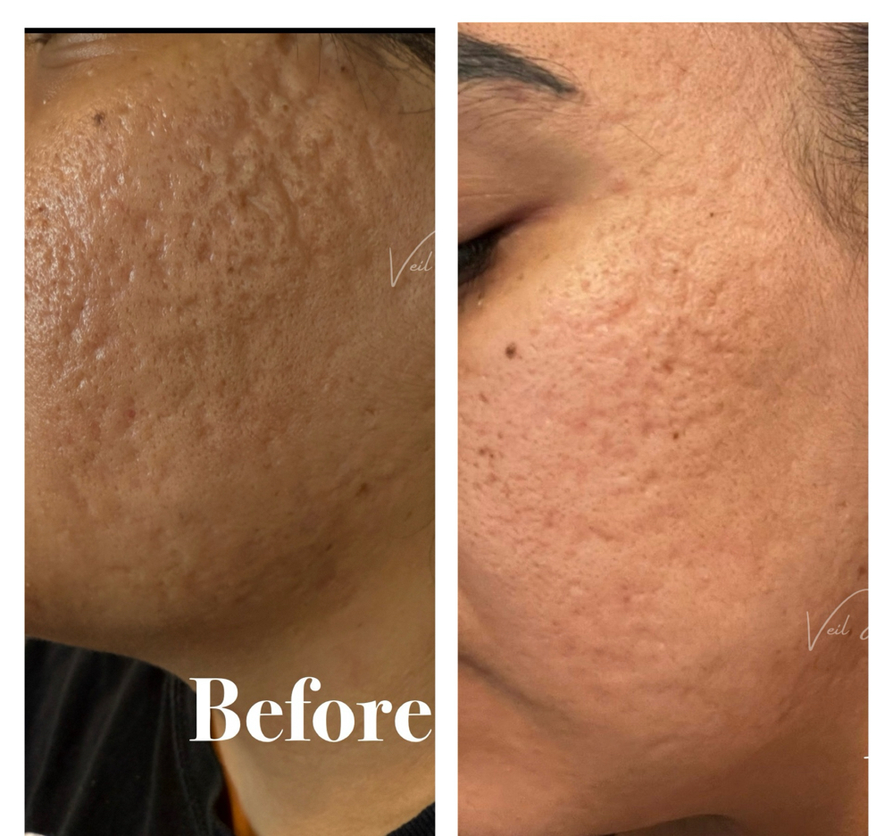 Acne Scar Treatment