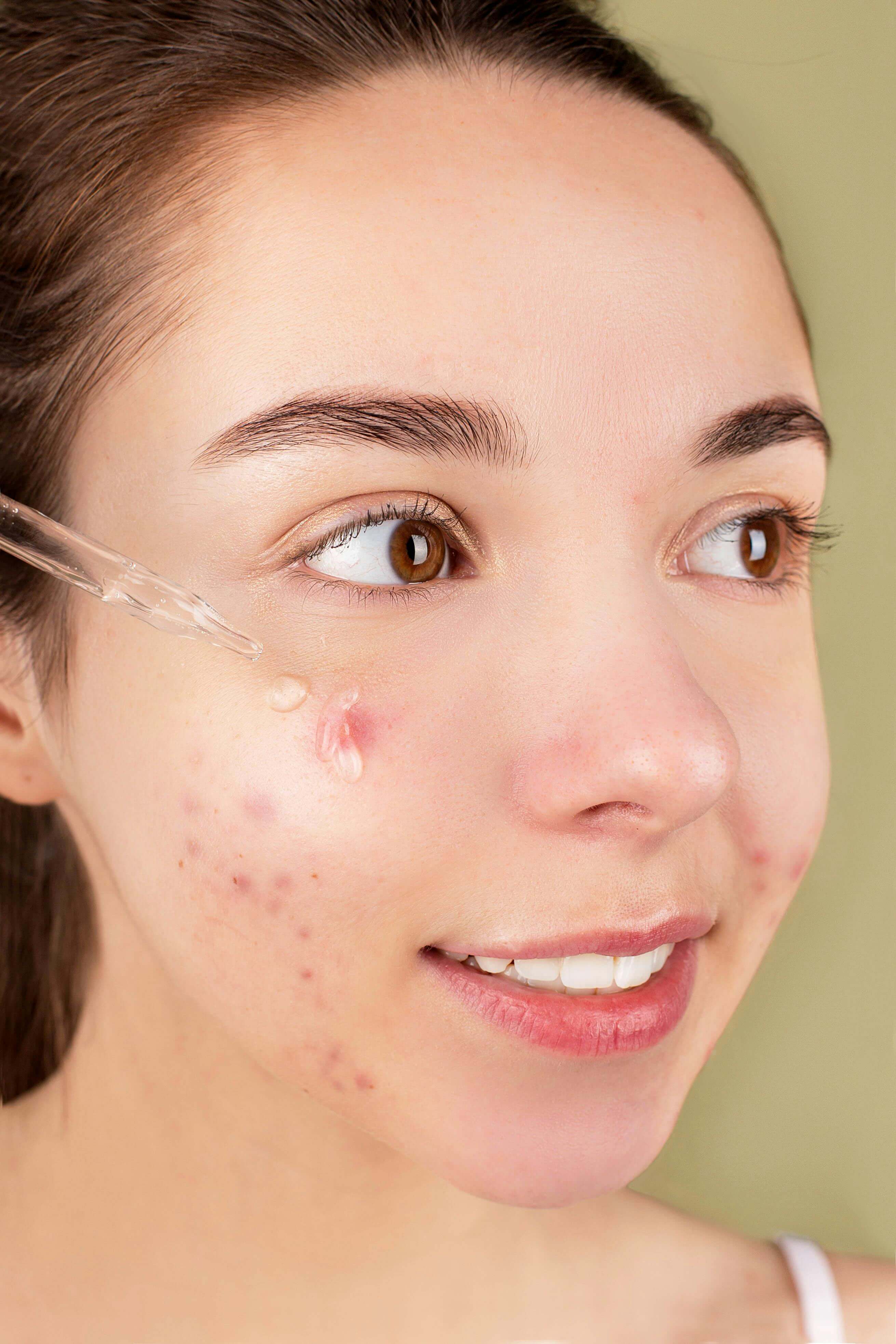 Acne Facial