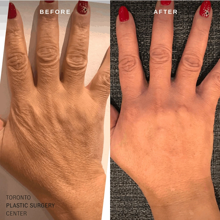 Hand Rejuvenation