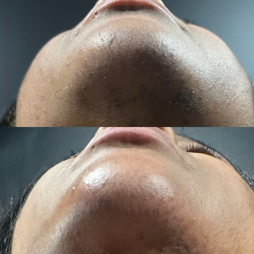 Chin & Neck