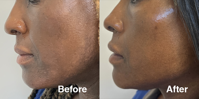 Microneedling Special