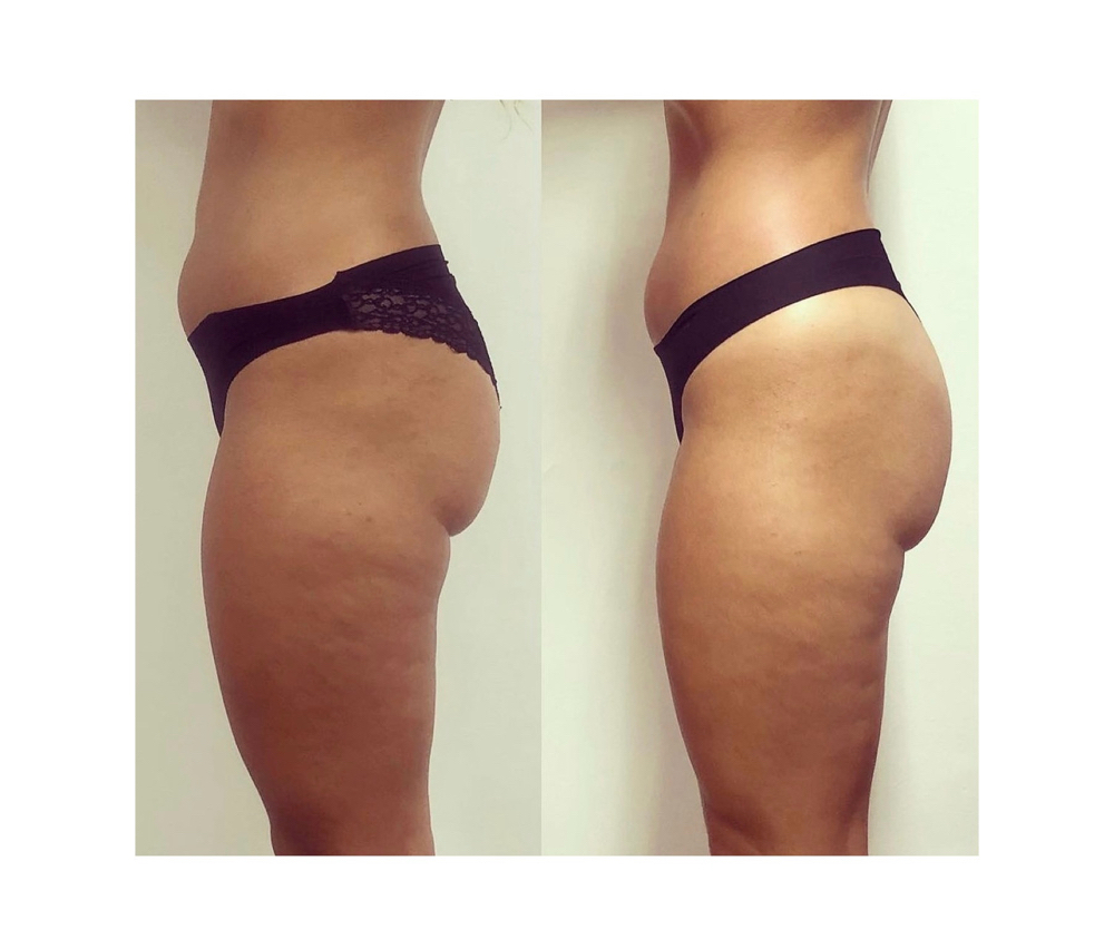 Packages Body Sculpting  14 Session