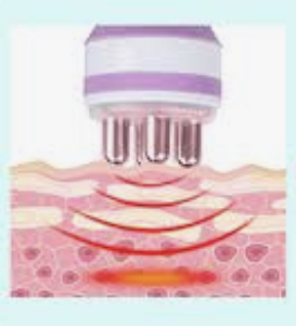RF & Cryo Therapy Series Of 4