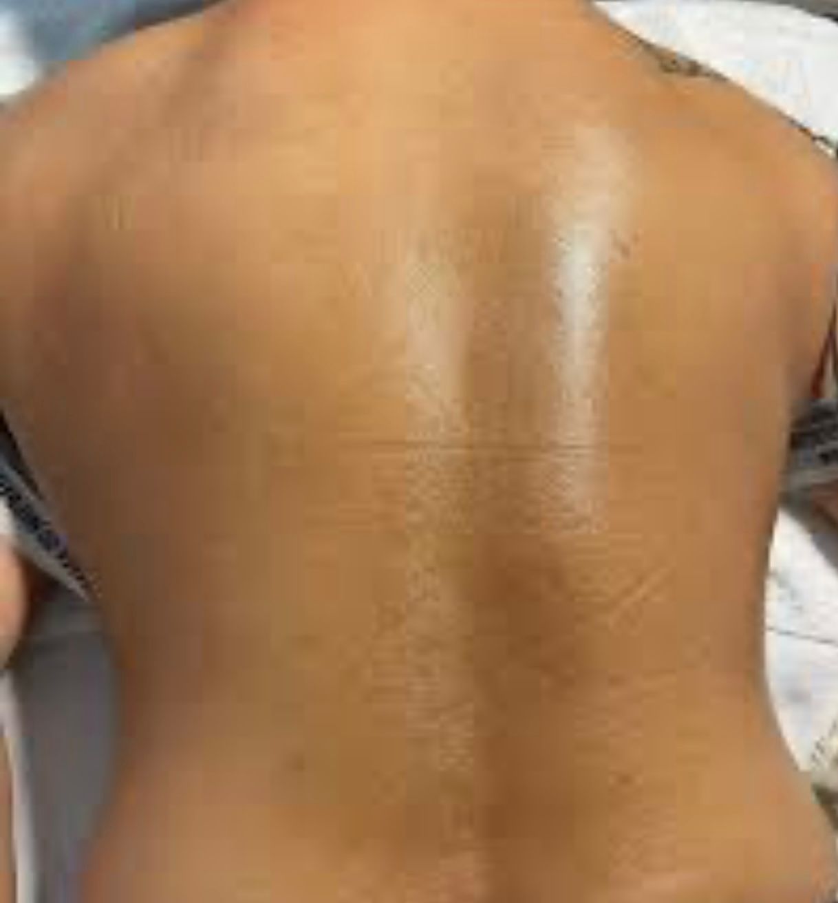 Back Facial at Estediva Aesthetics in Long Island City, NY