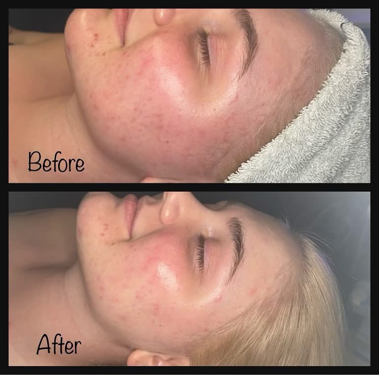 Hydrodermabrasion Facial