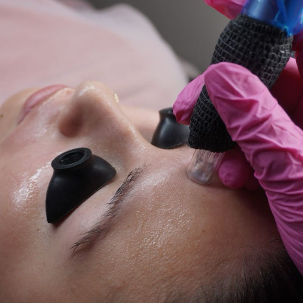 Nano Needling + BioRePeel at Dania's Dominican Beauty Salon in Hicksville, NY