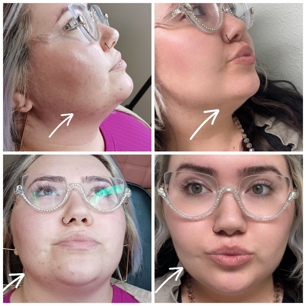 Jowls (Botox)