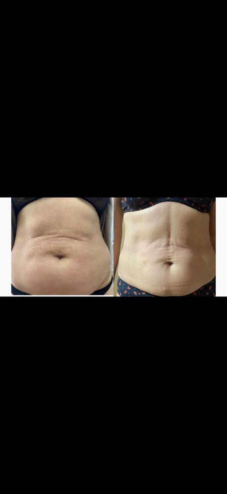 Cold Plasma tummy tuck