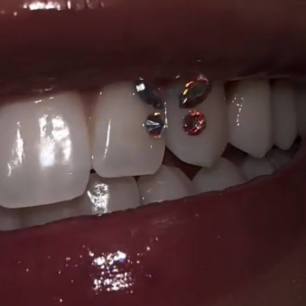 Tooth Gem - Butterfly Design at Teeth Whitening Lounge in Santa Ana, CA