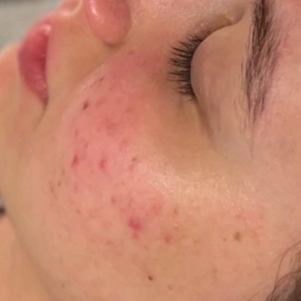 Entry Level Acne Program at Lux Beauty Esthétiques in Norcross, GA