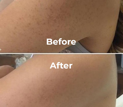 Body Chemical Peel