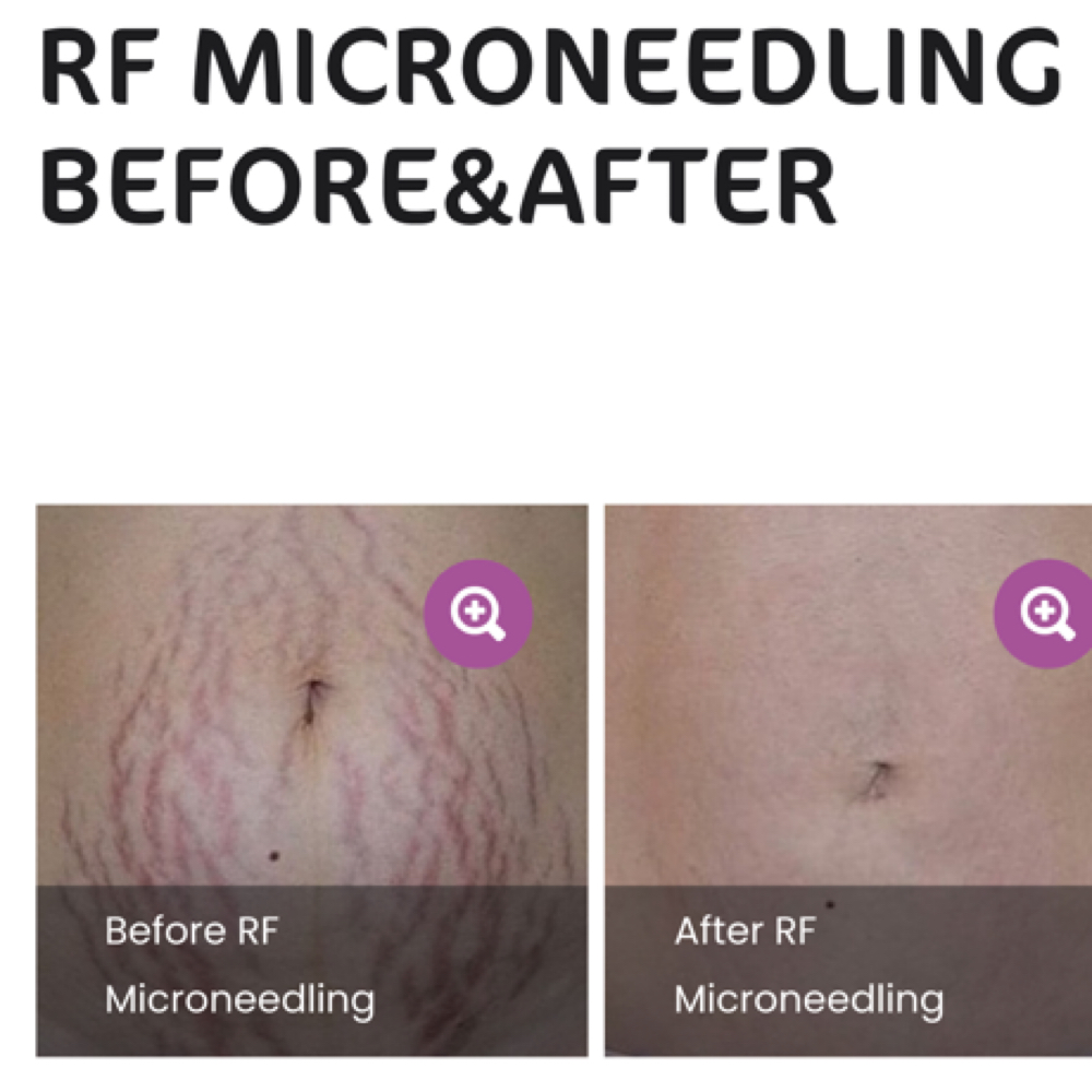 Stretch Mark Hyaloranic Treatment at Okchamali Spa in San Antonio, TX