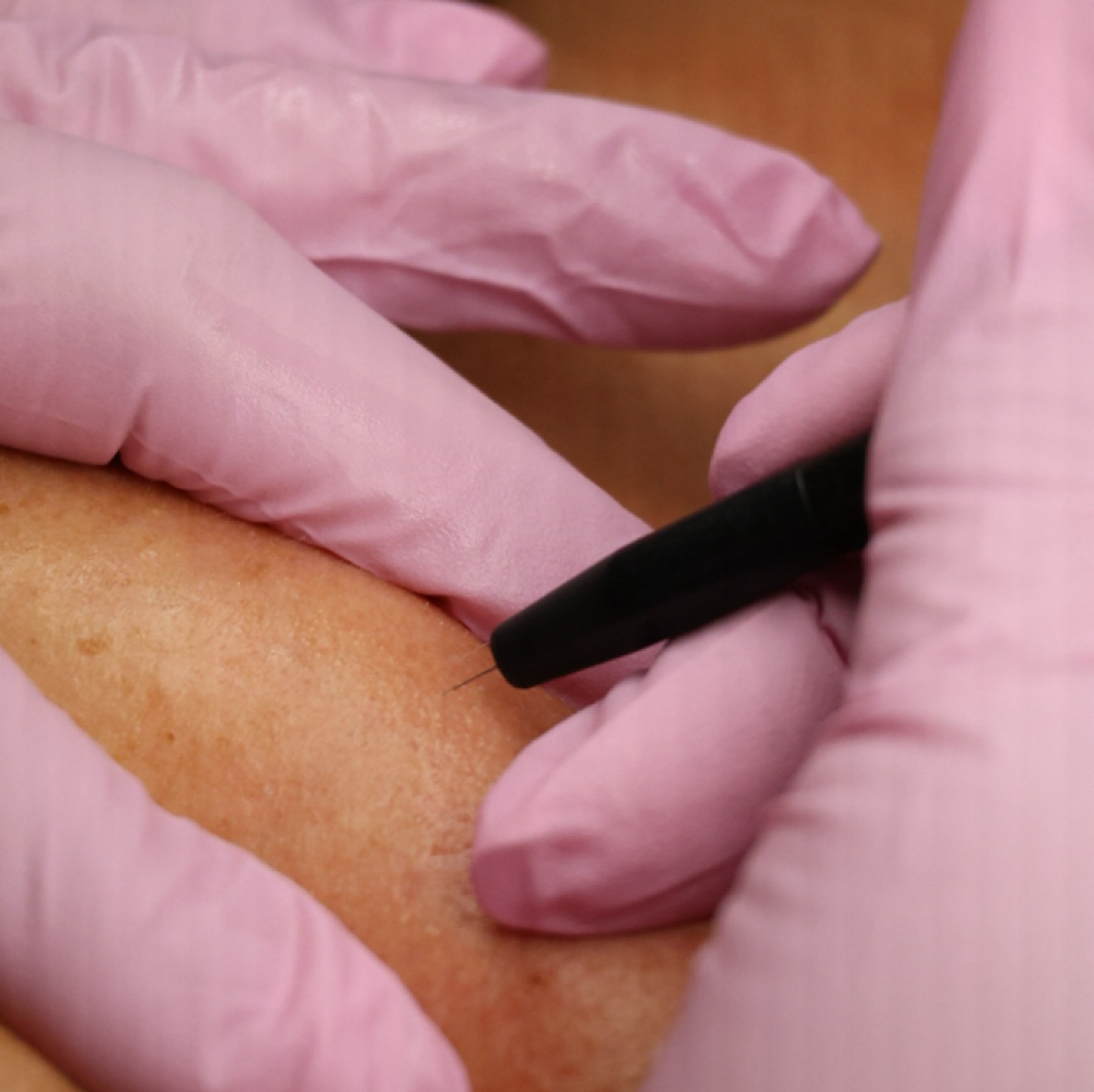 Electrolysis-15 minutes at Skin Studio 57 in Woburn, MA