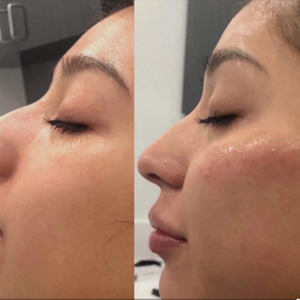 Cheek Filler at Boujee Asthetics ✨ in Tucson, AZ