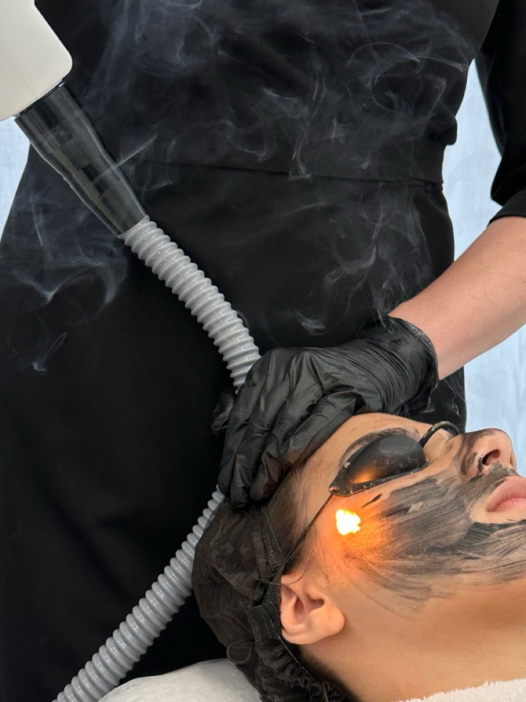 Laser Carbon Peeling at Alina PMUartist in Lincolnshire, IL