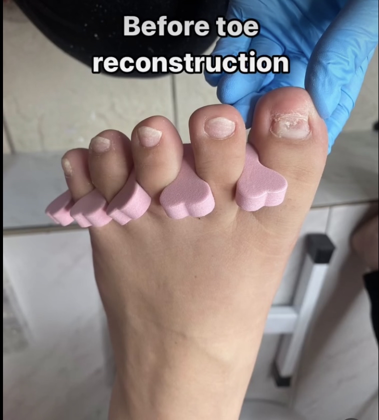 Toe Nail Reconstruction at GirlyGirlStudios in Visalia, CA