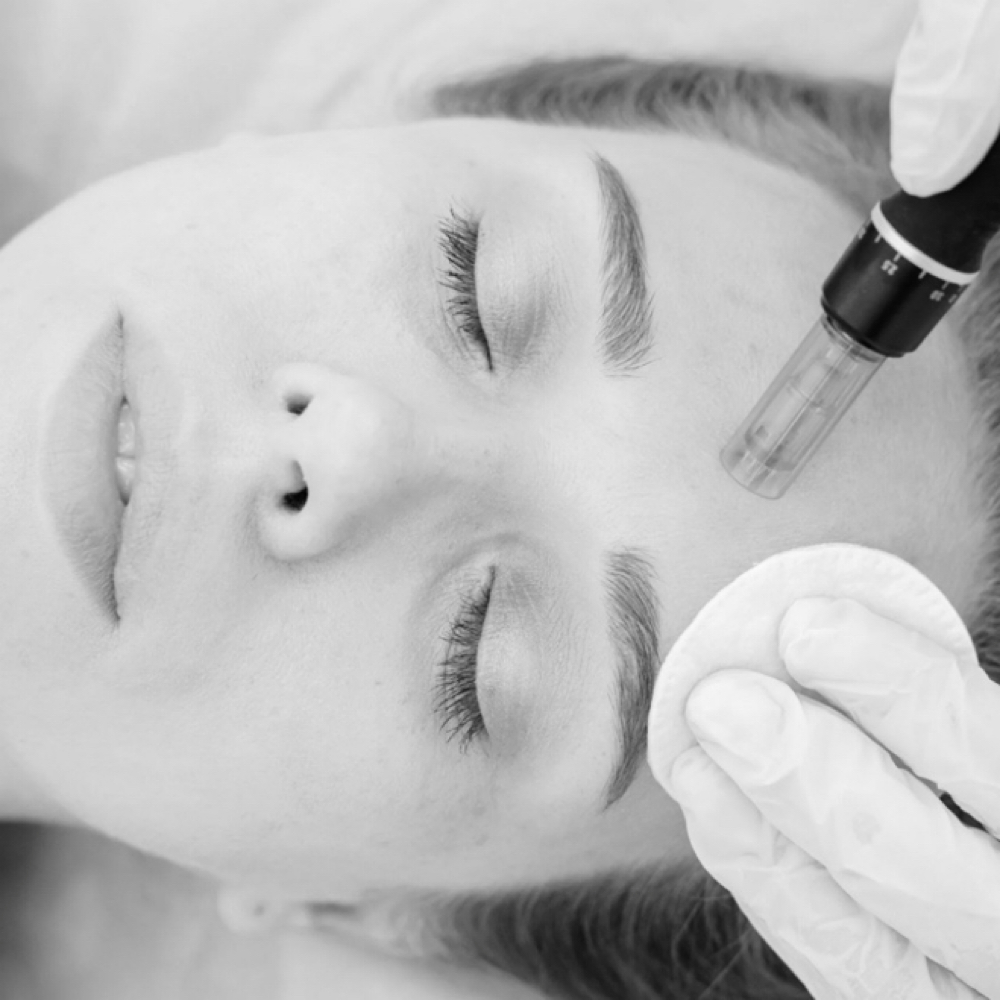 Microneedling With Facial at Beauty by Makenna in Lincoln, NE
