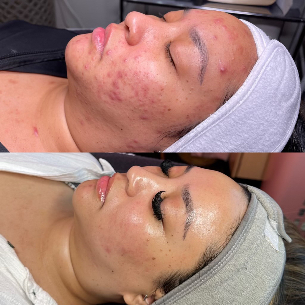 Acne Bootcamp Consult+Treatment