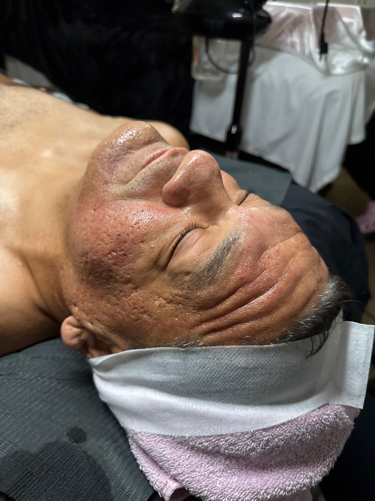 Microneedling Facial Treatment