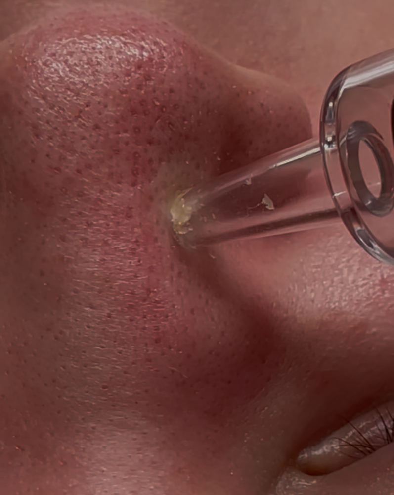 Extractions Add On