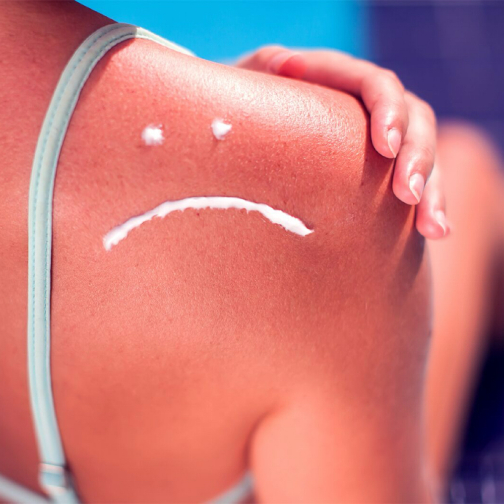 Sunburn Recovery Treatment at Bayou Glow, LLC in Larose, LA