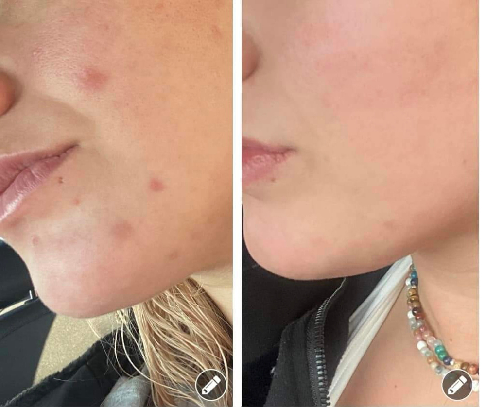 Microneedling