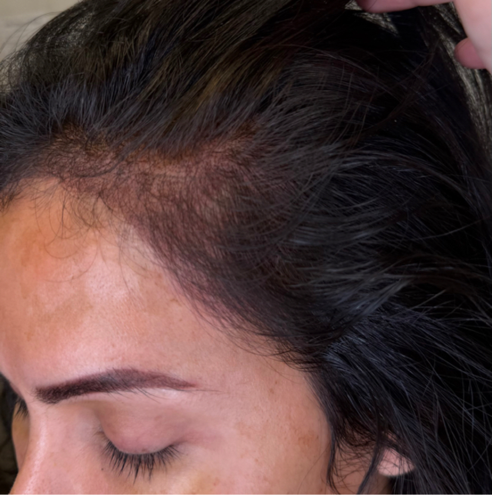 Scalp Micropigmentation at Vogetica Beauty Lab (Regina) in Dallas, TX