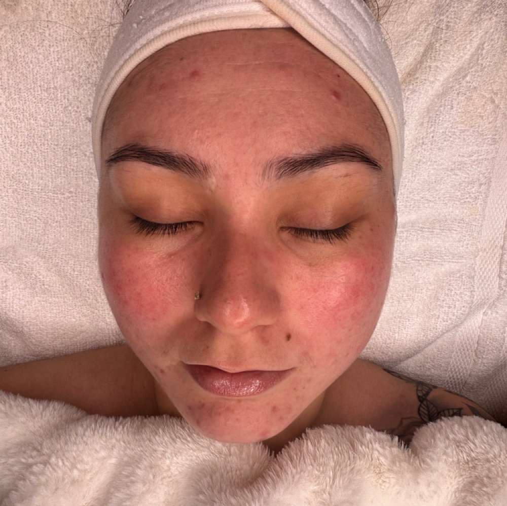 Treatment Follow Up at Luv U Aesthetics in Goodyear, AZ