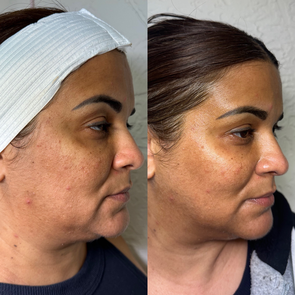 Microcurrent Facial Toning