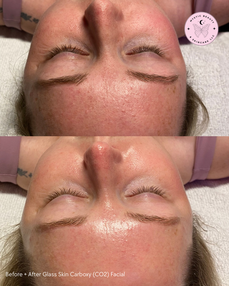 Glass Skin Carboxy (CO₂) Facial