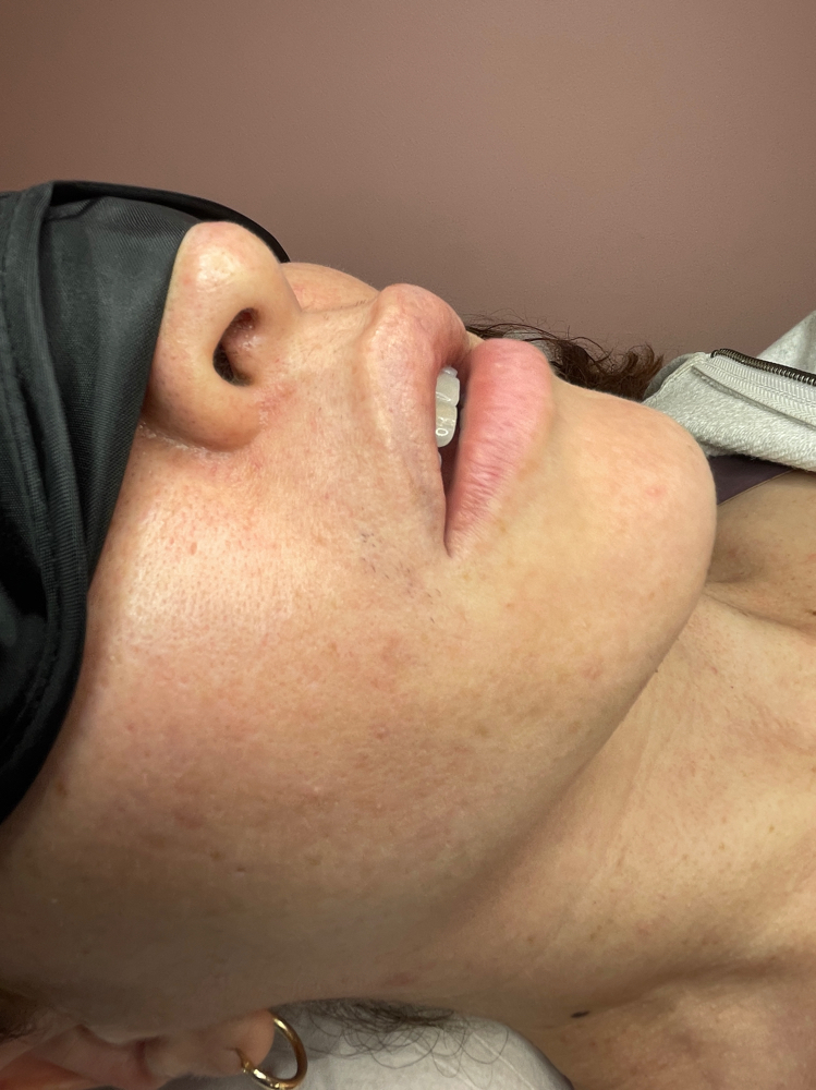 Electrolysis 45 min