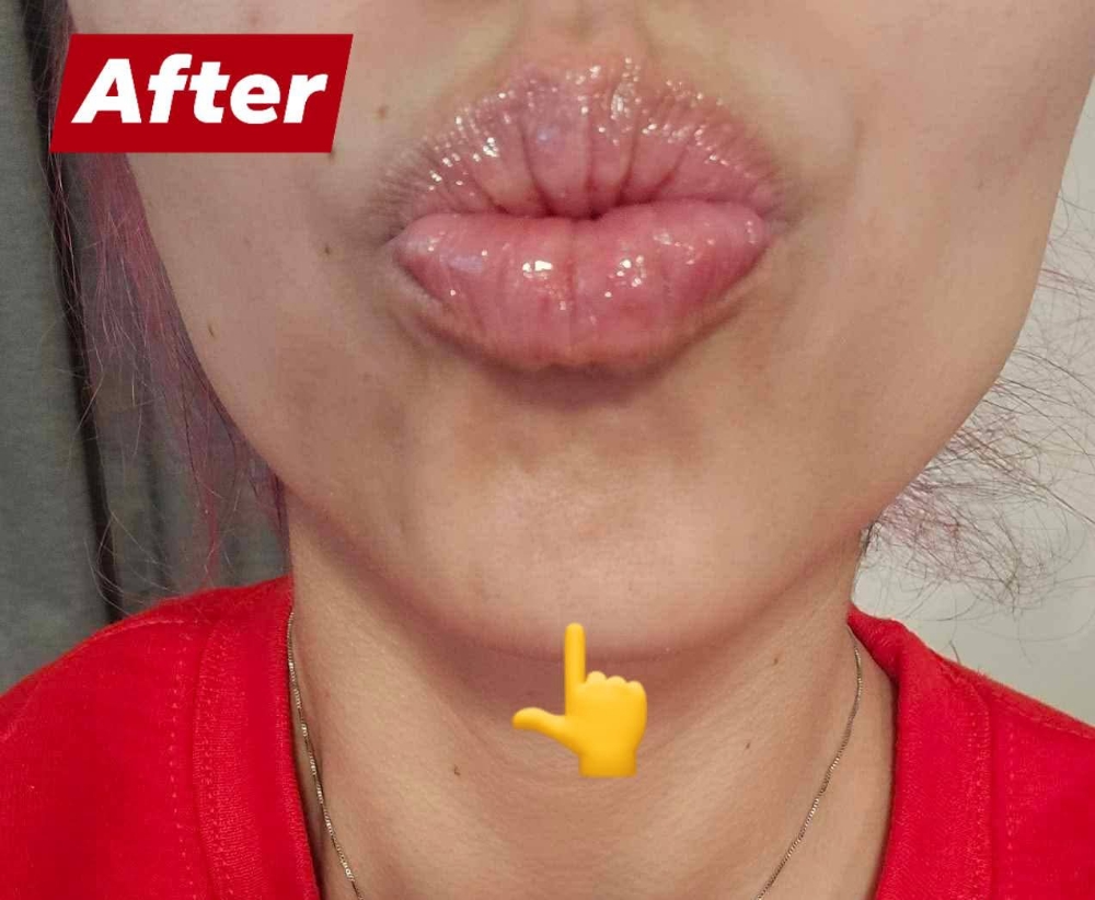 Mentalis (Chin Dimples Botox) at Lavish Luxuries in Lubbock, TX