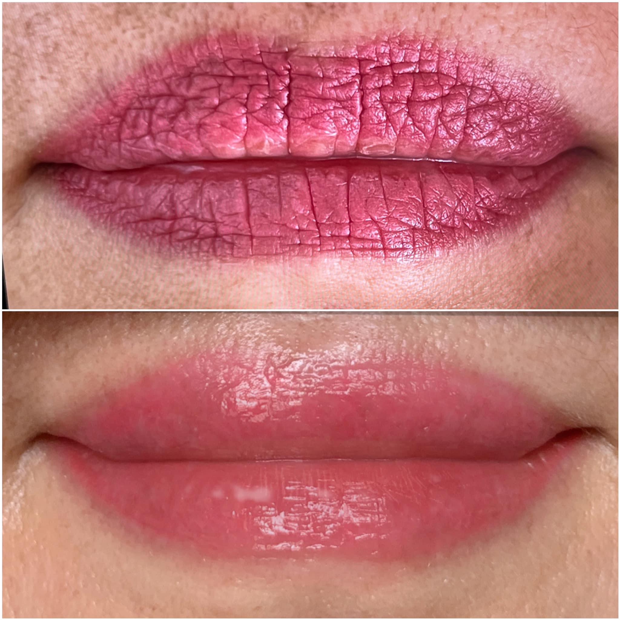 PLASMA LIP REJUVENATION