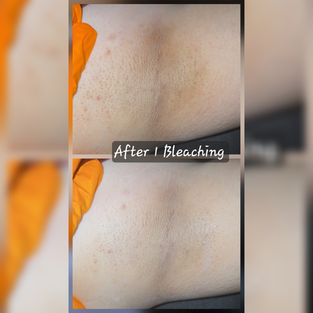 Monthly Sale 5 Bleaching