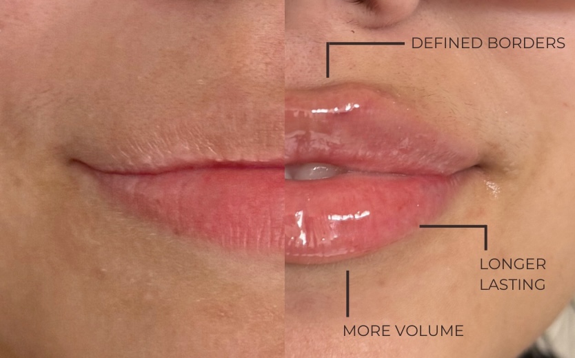 Microneedle Lip Filler