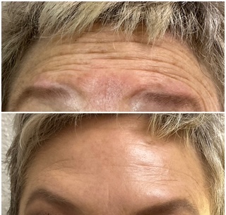 Wrinkle Relaxers (Xeomin & Letybo)