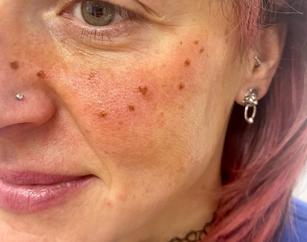 Faux Freckles