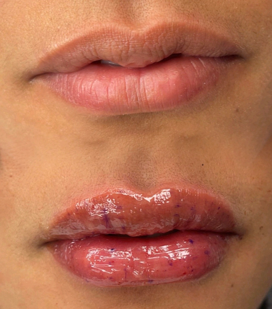 1ML NEEDLE-LESS LIP FILLER