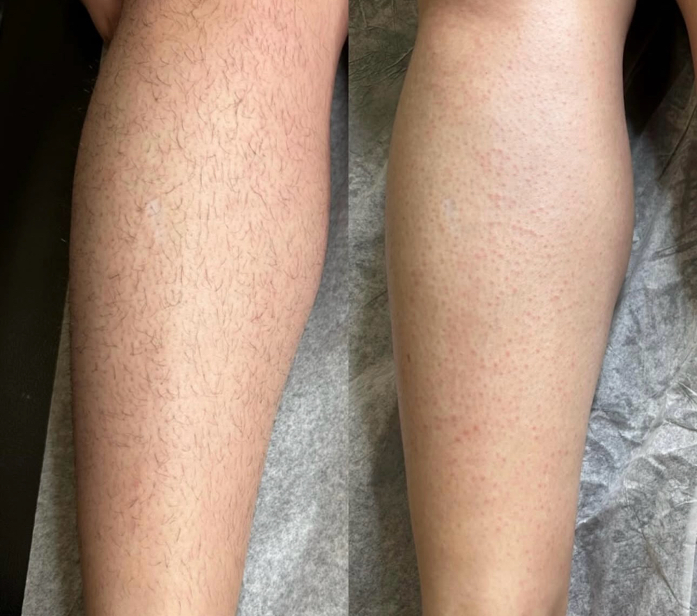 Half leg wax (female anatomy)