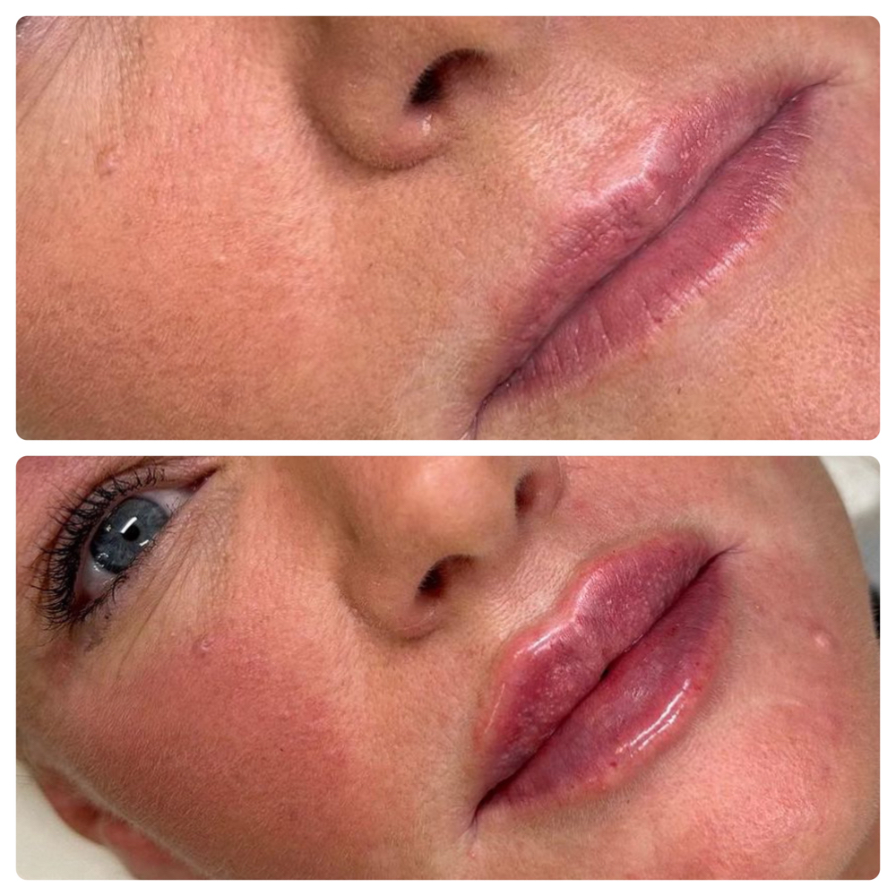 Lip Filler 1.5