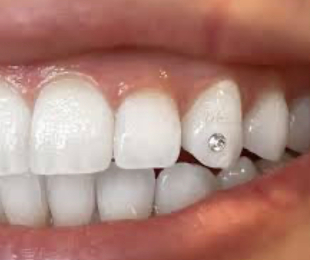 Tooth Gems